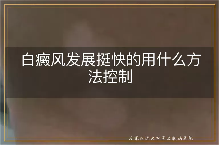 白癜风发展挺快的用什么方法控制