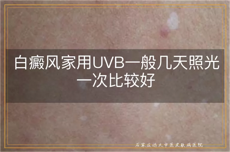 白癜风家用UVB一般几天照光一次比较好