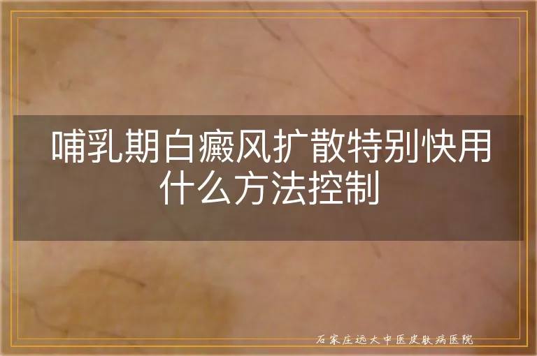 哺乳期白癜风扩散特别快用什么方法控制