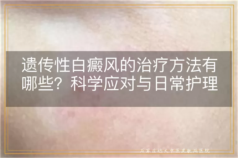 遗传性白癜风的治疗方法有哪些?科学应对与日常护理全攻略