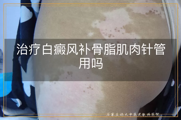 治疗白癜风补骨脂肌肉针管用吗