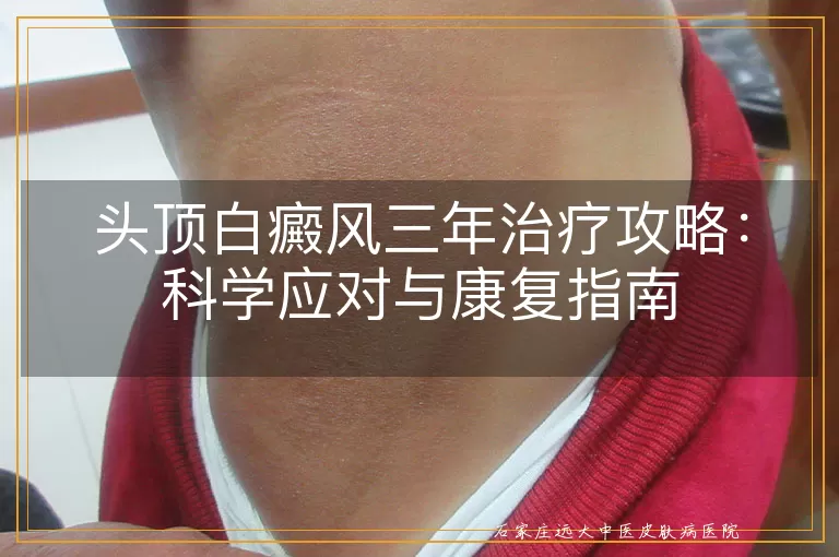 头顶白癜风三年治疗攻略:科学应对与康复指南