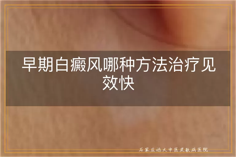 早期白癜风哪种方法治疗见效快