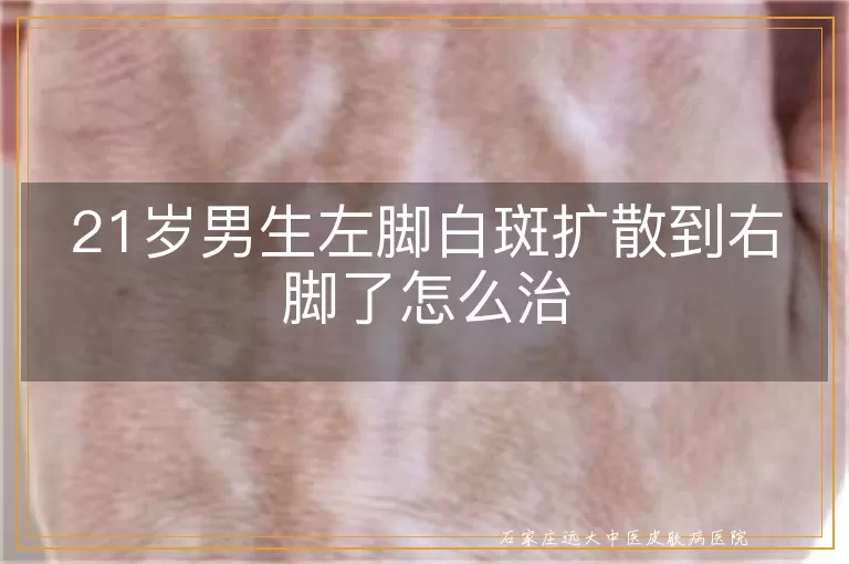 21岁男生左脚白斑扩散到右脚了怎么治