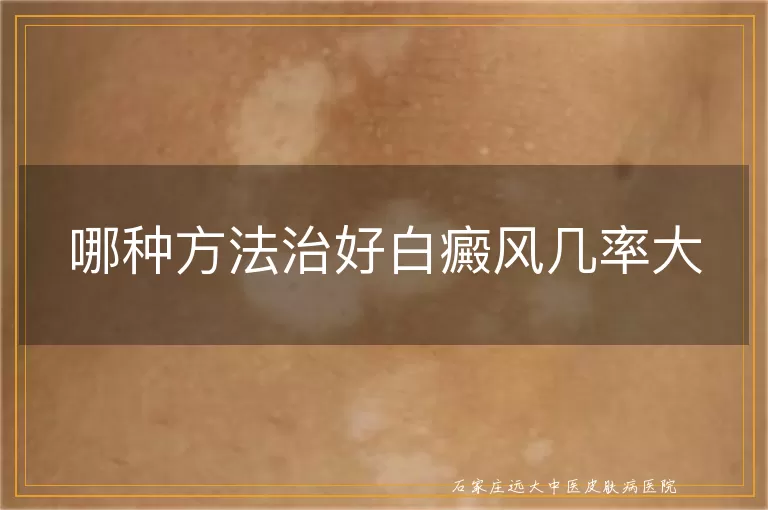 哪种方法治好白癜风几率大