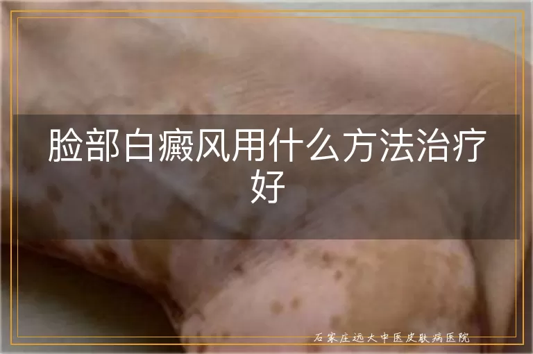 脸部白癜风用什么方法治疗好