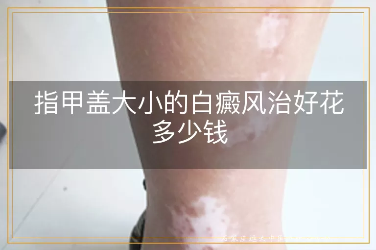 指甲盖大小的白癜风治好花多少钱