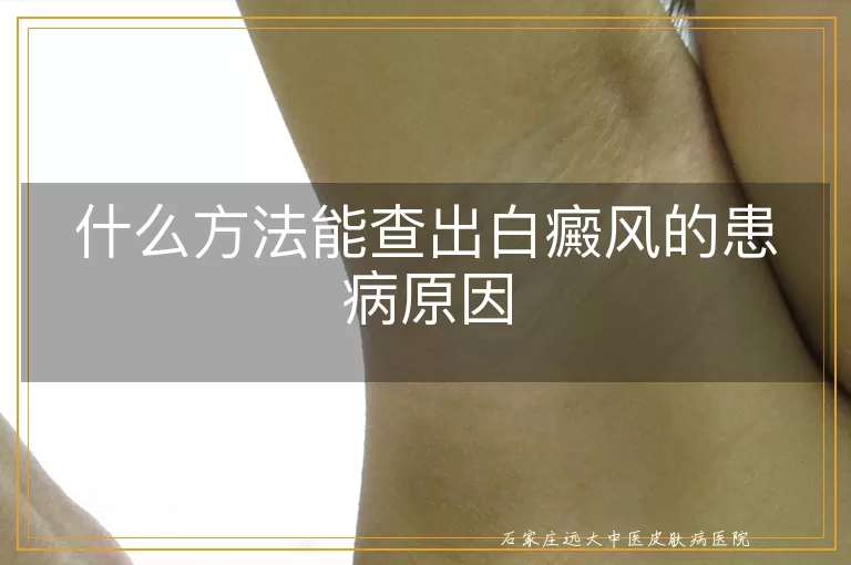 什么方法能查出白癜风的患病原因