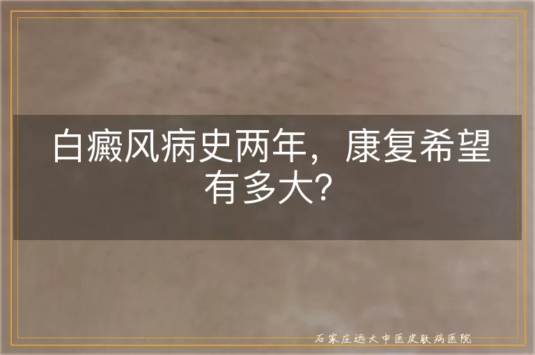 白癜风病史两年，康复希望有多大？