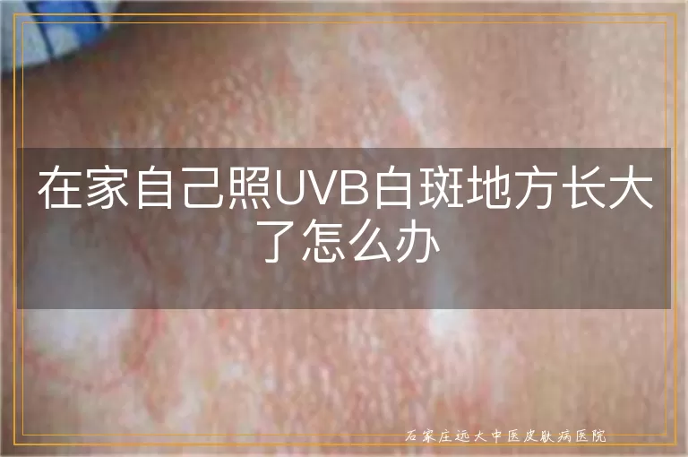 在家自己照UVB白斑地方长大了怎么办