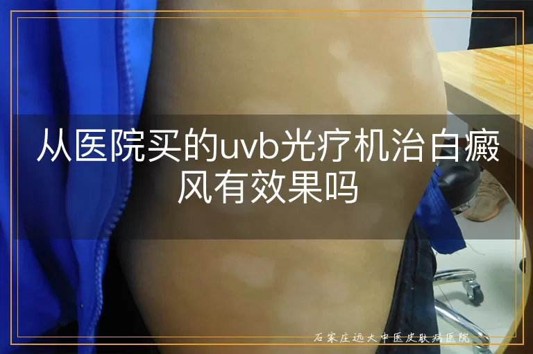 从医院买的uvb光疗机治白癜风有效果吗
