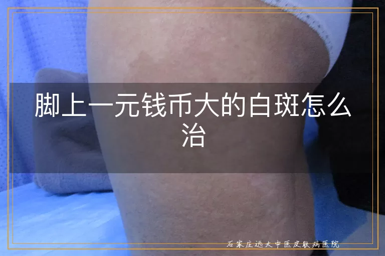 脚上一元钱币大的白斑怎么治