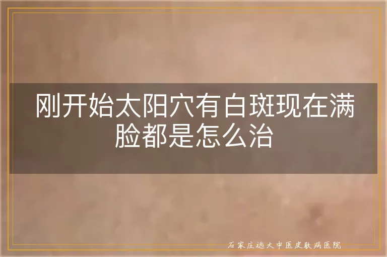 刚开始太阳穴有白斑现在满脸都是怎么治