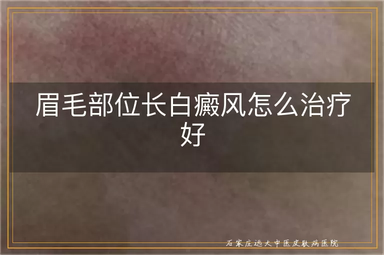 眉毛部位长白癜风怎么治疗好