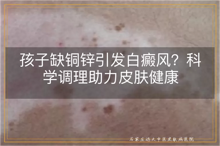 孩子缺铜锌引发白癜风?科学调理助力皮肤健康