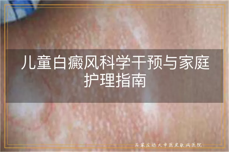 儿童白癜风科学干预与家庭护理指南