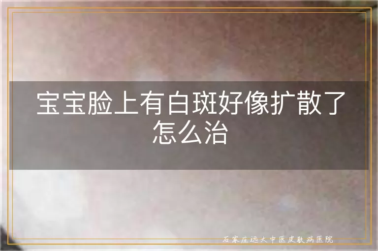 宝宝脸上有白斑好像扩散了怎么治
