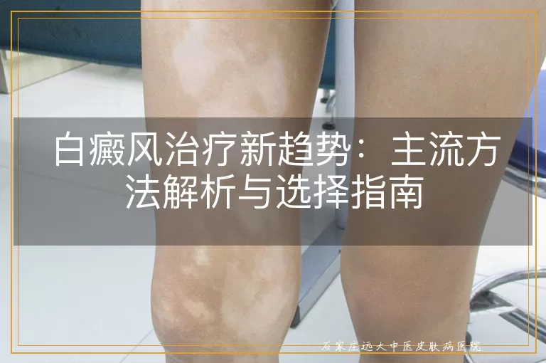 白癜风治疗新趋势:主流方法解析与选择指南