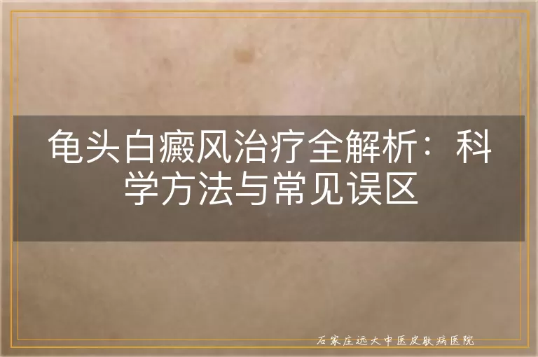 龟头白癜风治疗全解析:科学方法与常见误区