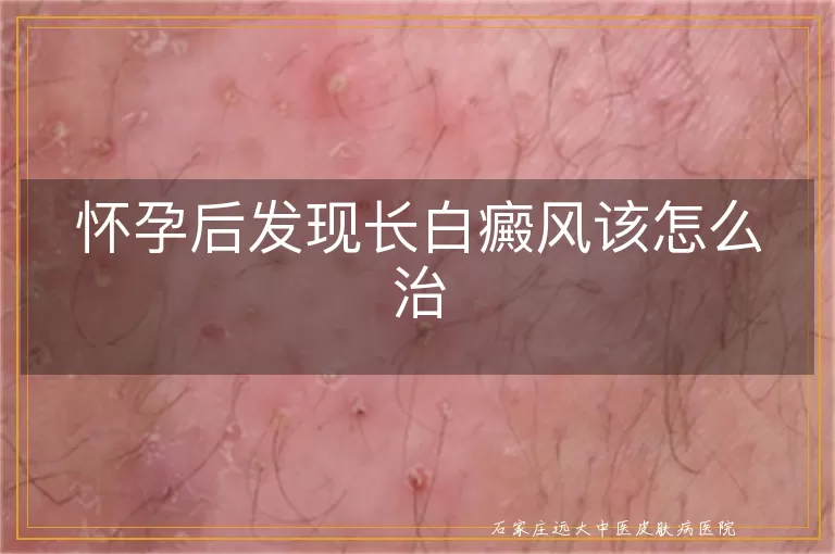 怀孕后发现长白癜风该怎么治