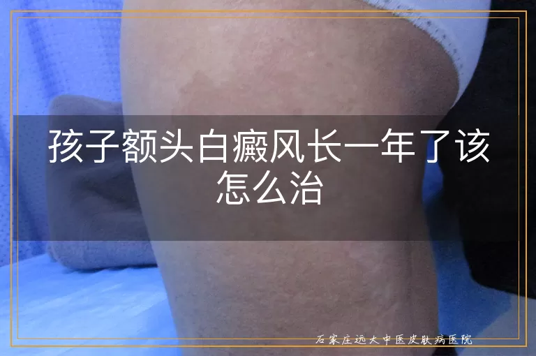 孩子额头白癜风长一年了该怎么治