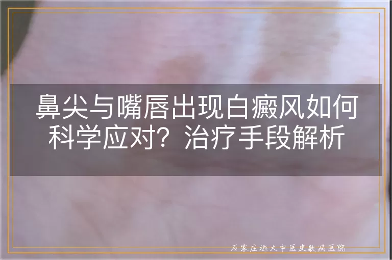鼻尖与嘴唇出现白癜风如何科学应对？治疗手段解析