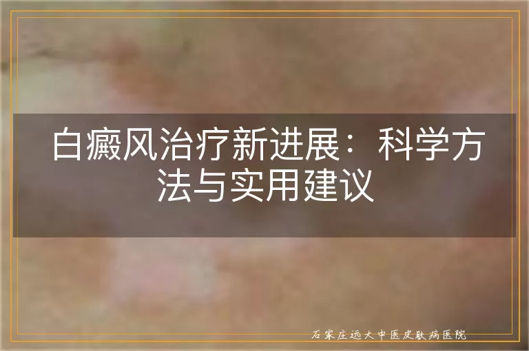 白癜风治疗新进展：科学方法与实用建议