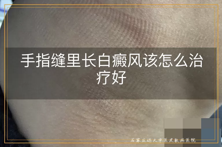 手指缝里长白癜风该怎么治疗好