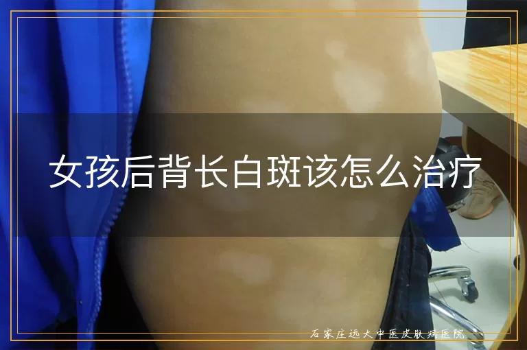 女孩后背长白斑该怎么治疗