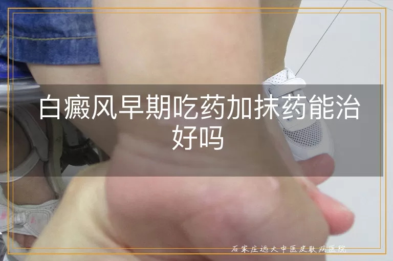 白癜风早期吃药加抹药能治好吗