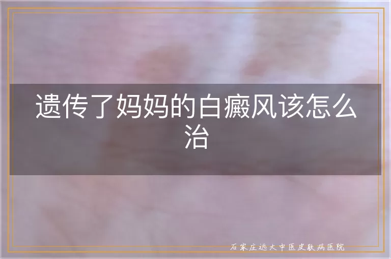 遗传了妈妈的白癜风该怎么治