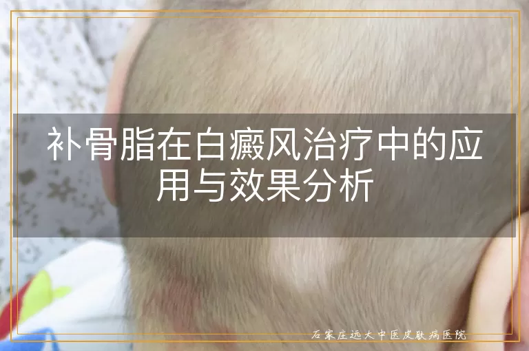补骨脂在白癜风治疗中的应用与效果分析