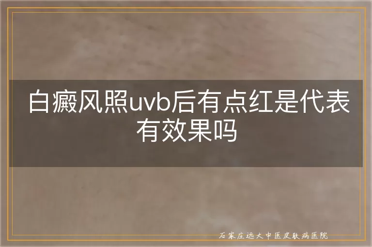 白癜风照uvb后有点红是代表有效果吗