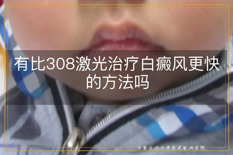 有比308激光治疗白癜风更快的方法吗