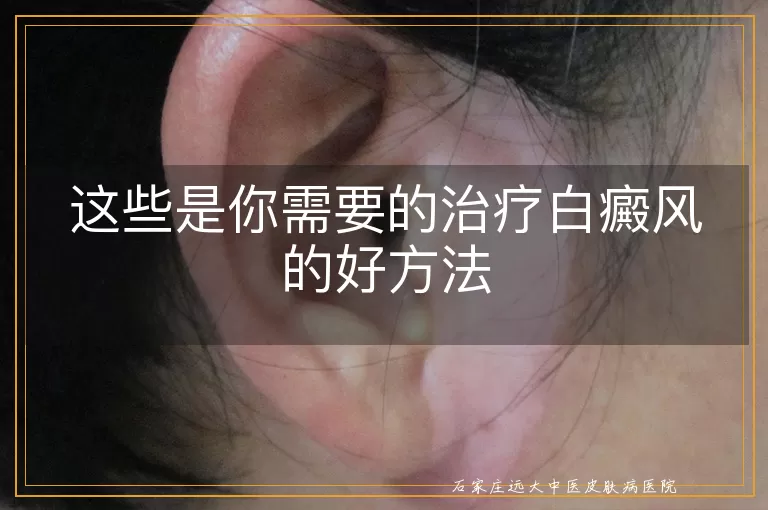 这些是你需要的治疗白癜风的好方法
