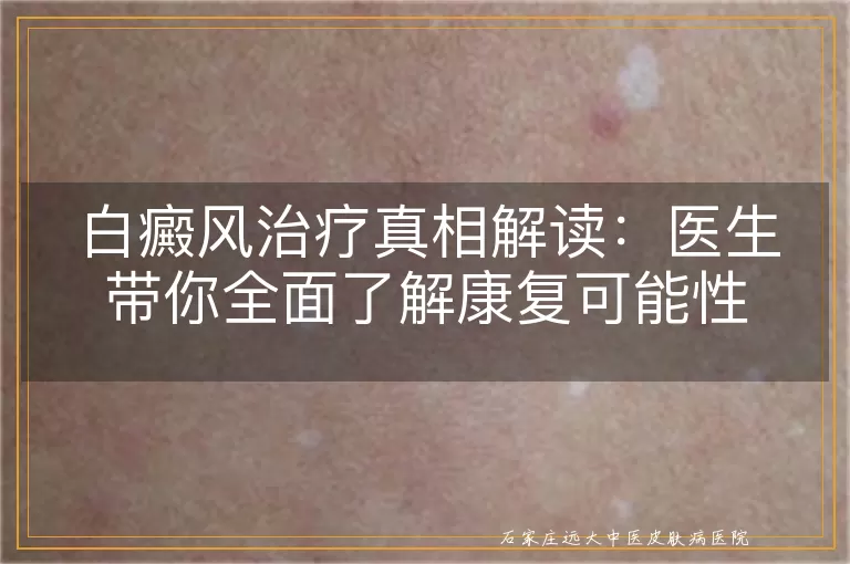 白癜风治疗真相解读：医生带你全面了解康复可能性