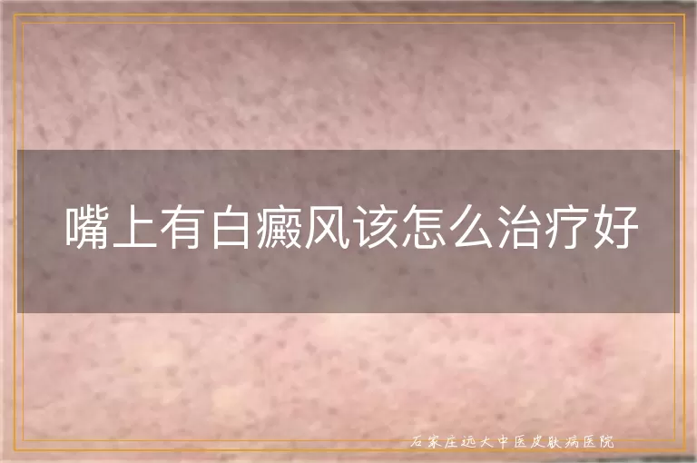 嘴上有白癜风该怎么治疗好