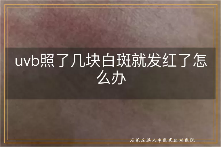 uvb照了几块白斑就发红了怎么办