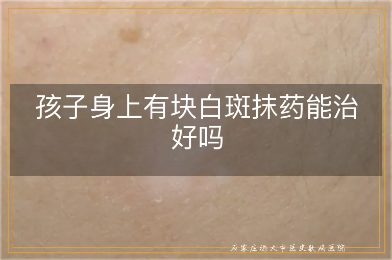 孩子身上有块白斑抹药能治好吗