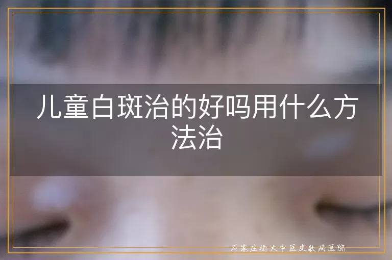 儿童白斑治的好吗用什么方法治