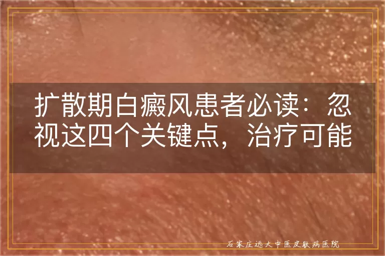 扩散期白癜风患者必读：忽视这四个关键点，治疗可能事倍功半