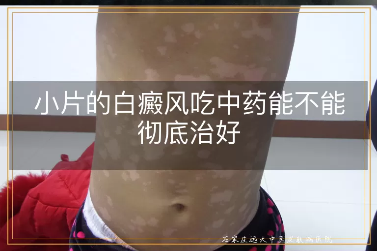 小片的白癜风吃中药能不能彻底治好
