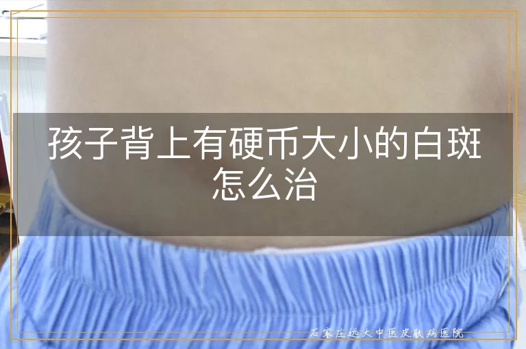 孩子背上有硬币大小的白斑怎么治
