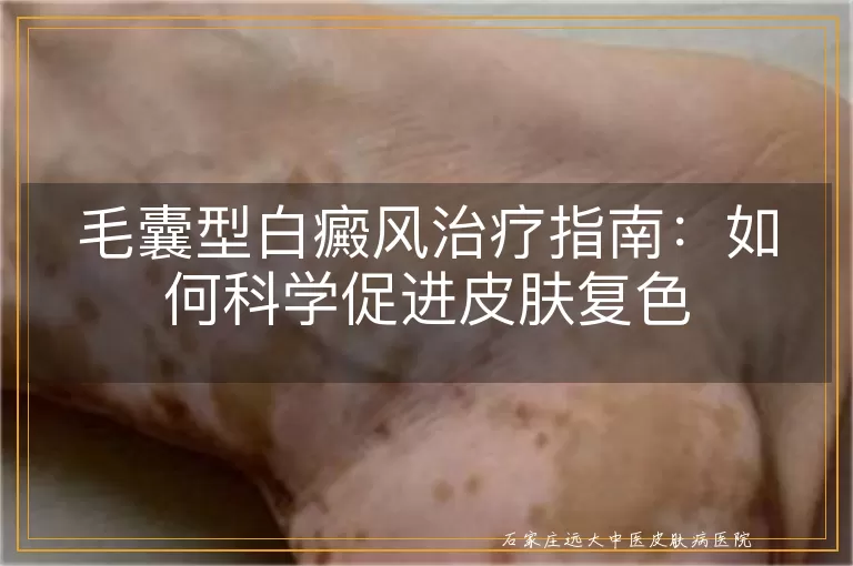毛囊型白癜风治疗指南：如何科学促进皮肤复色