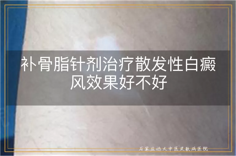 补骨脂针剂治疗散发性白癜风效果好不好