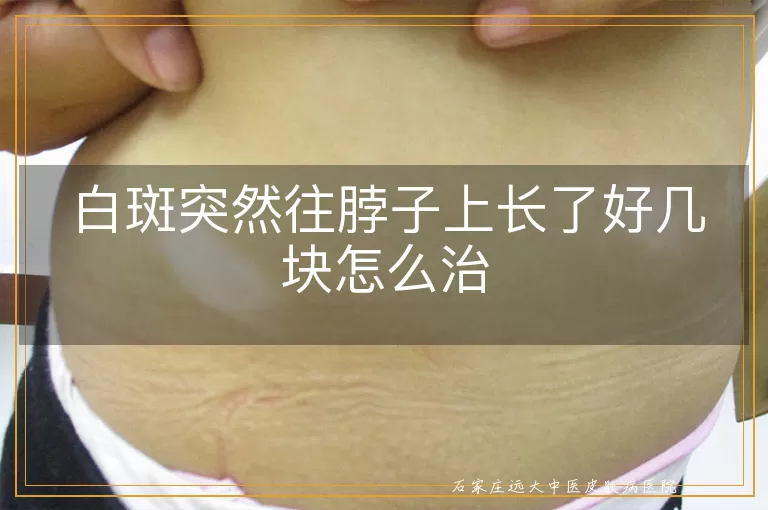 白斑突然往脖子上长了好几块怎么治