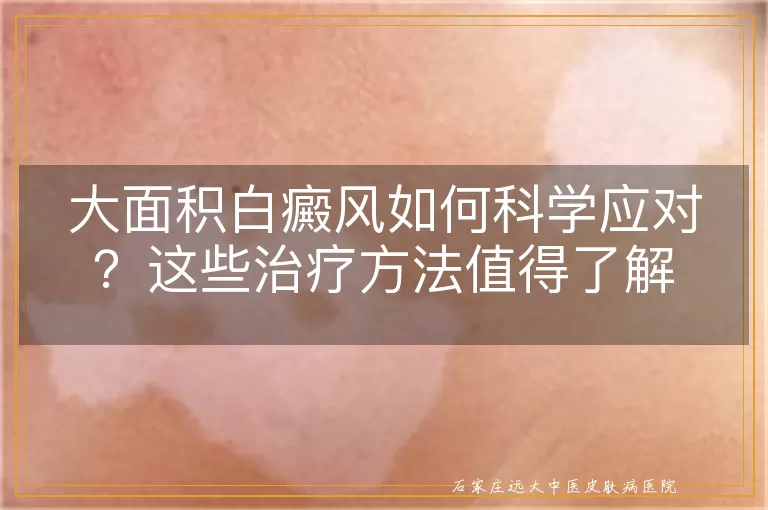 大面积白癜风如何科学应对？这些治疗方法值得了解