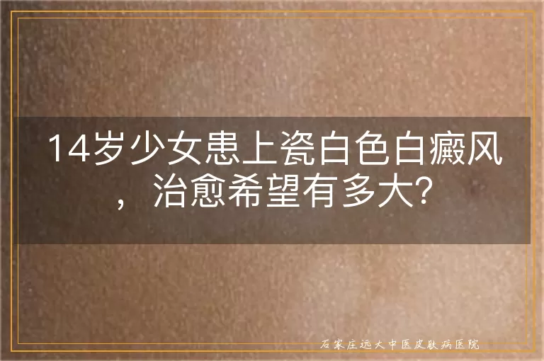 14岁少女患上瓷白色白癜风，治愈希望有多大？