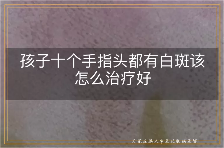 孩子十个手指头都有白斑该怎么治疗好