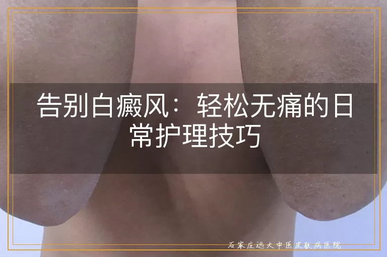 告别白癜风：轻松无痛的日常护理技巧